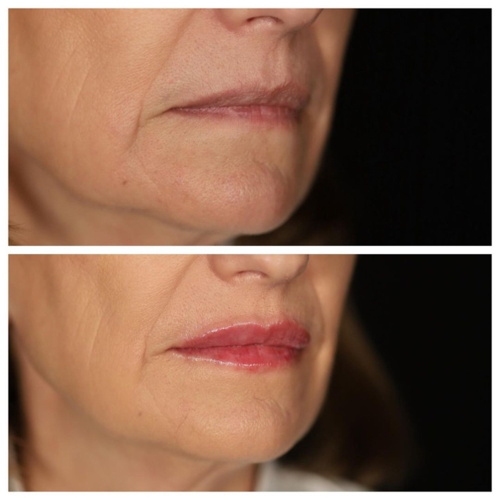 Medicina estética labios