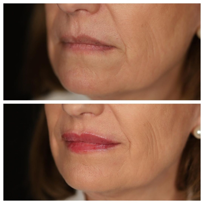 Medicina estética labios