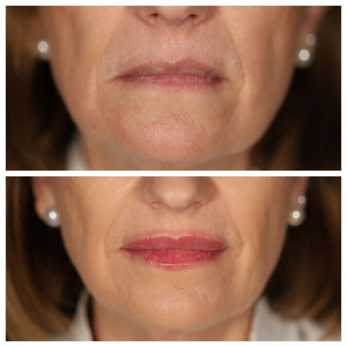 Cirugía Plástica Facial cambios