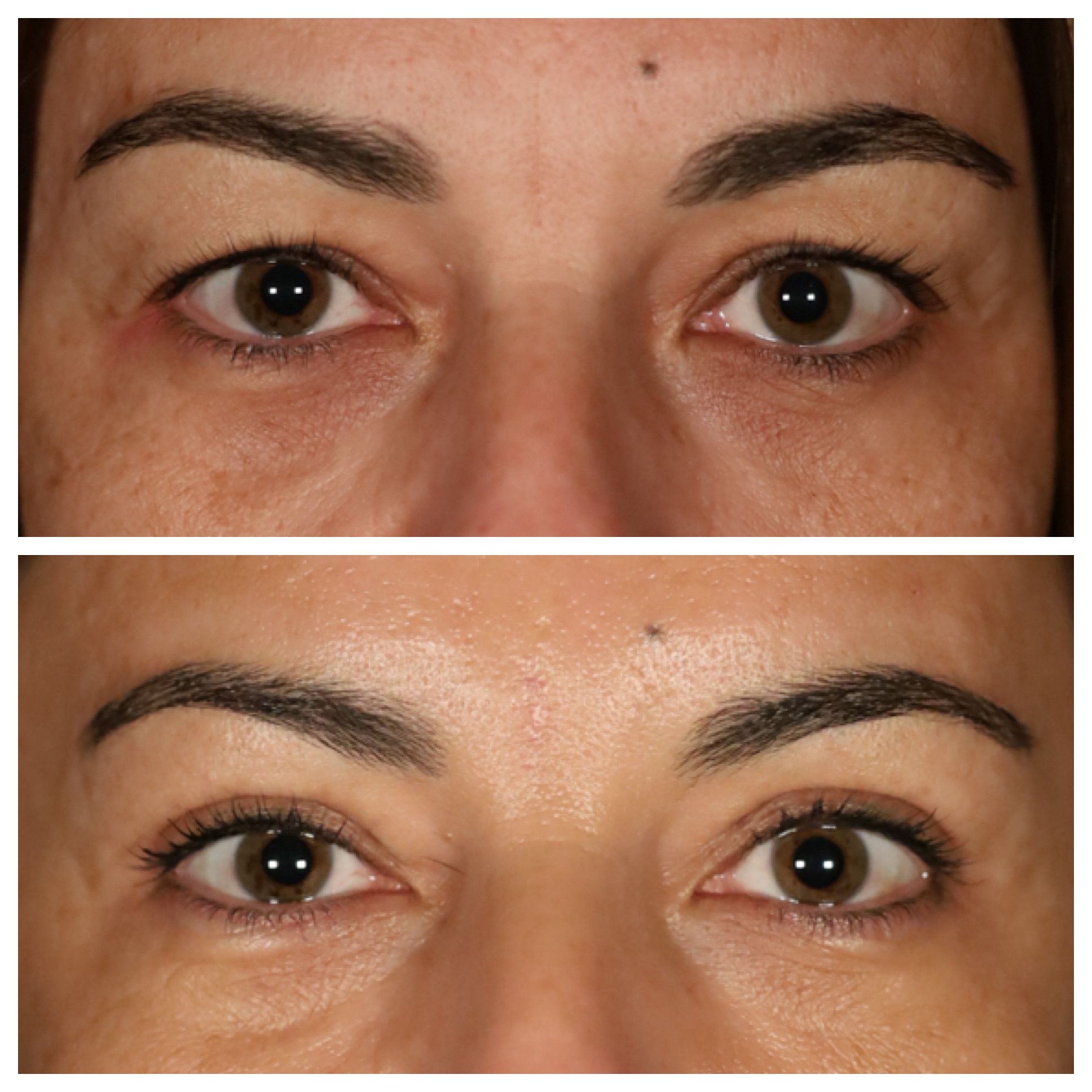 Blefaroplastia inferior