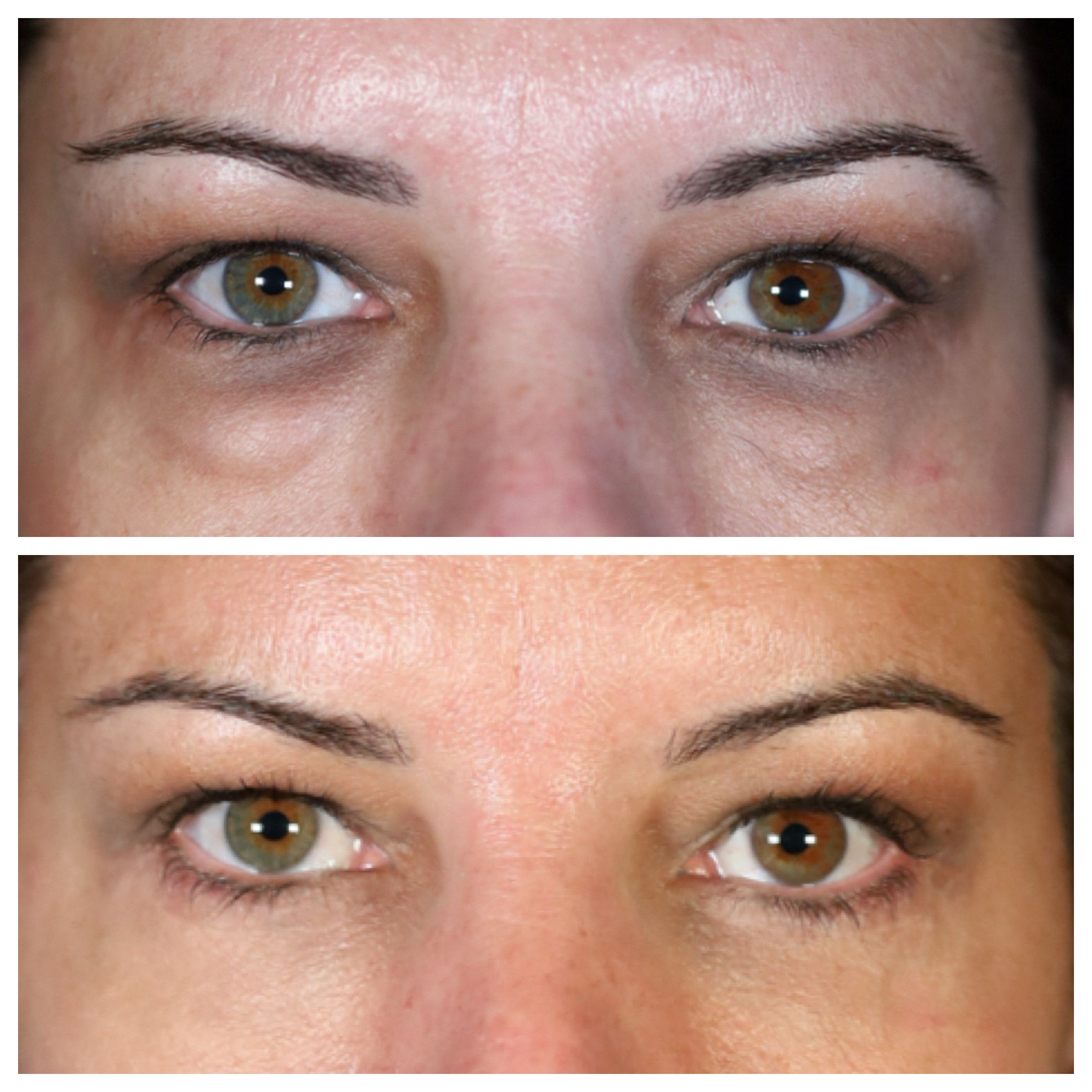 Blefaroplastia completa