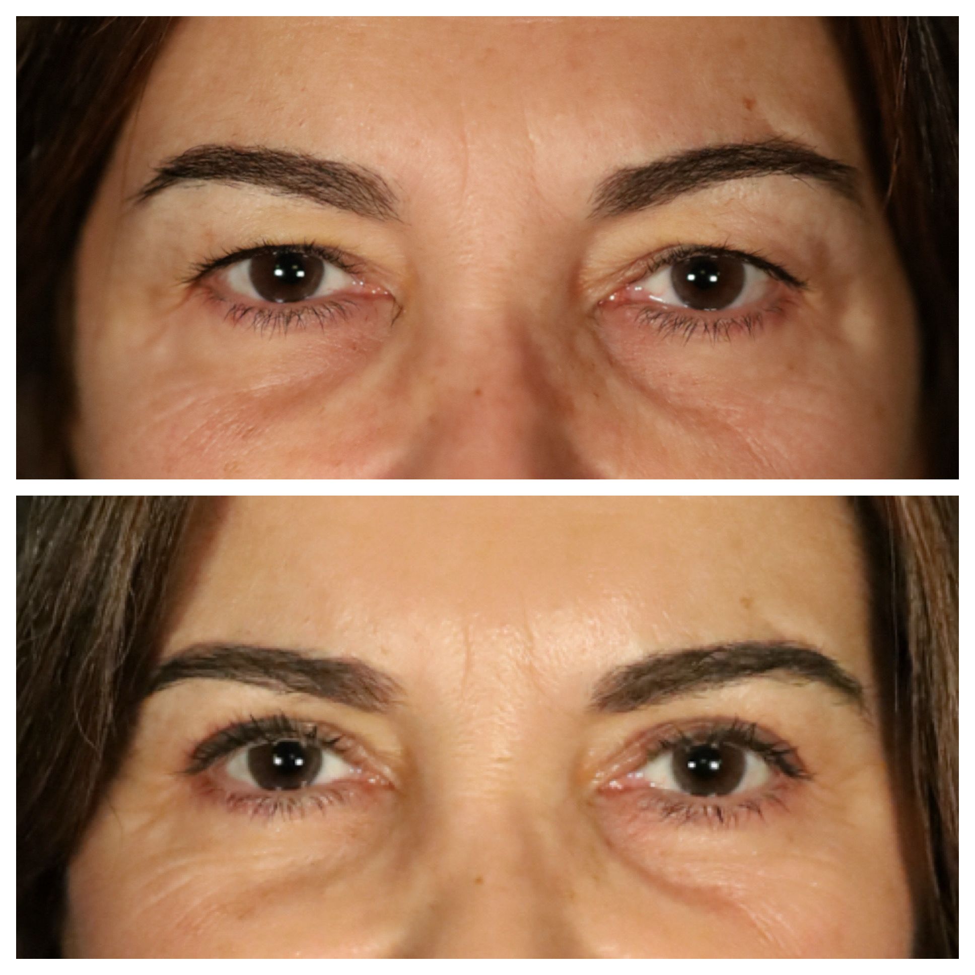 Blefaroplastia superior