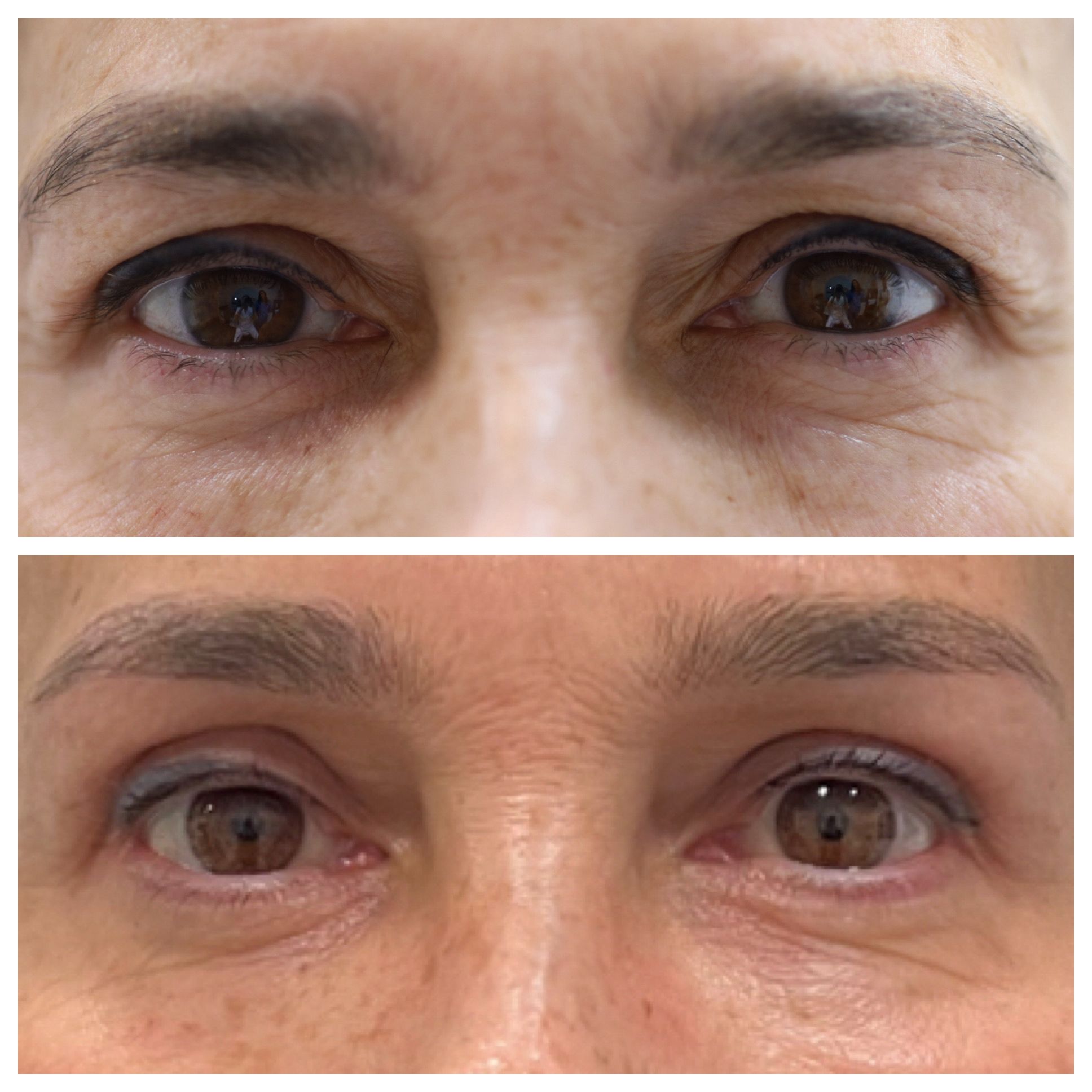 Blefaroplastia superior con elevación de cejas