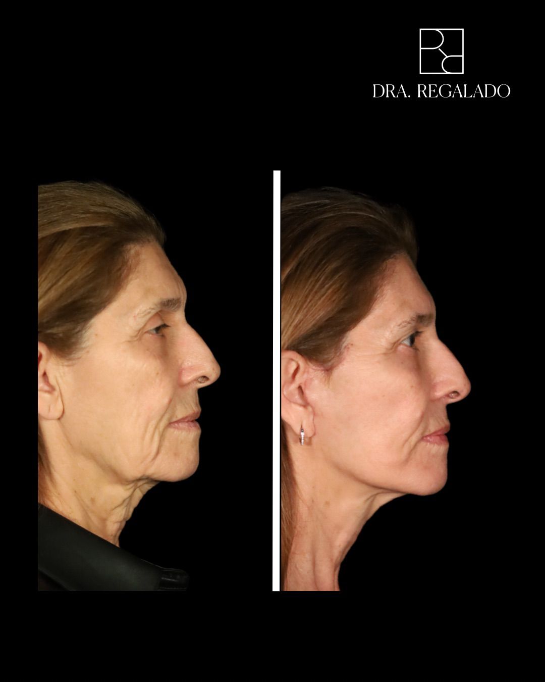 Minilifting cérvico-facial