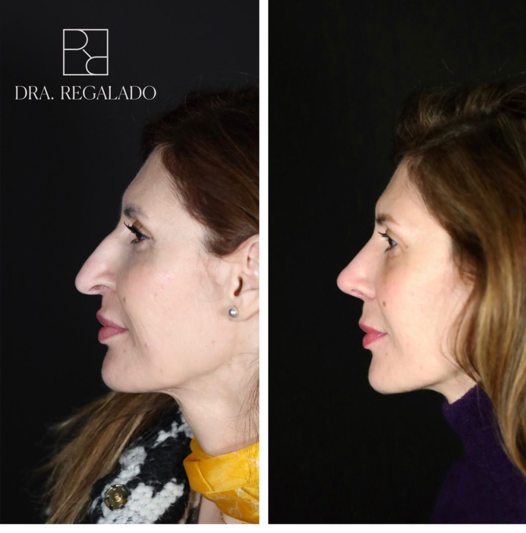 Rinoplastia ultrasónica