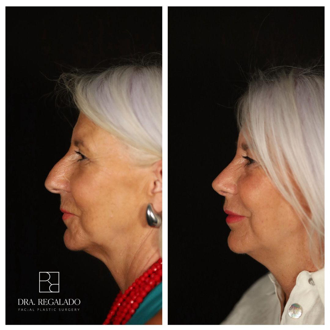 Rinoplastia ultrasónica