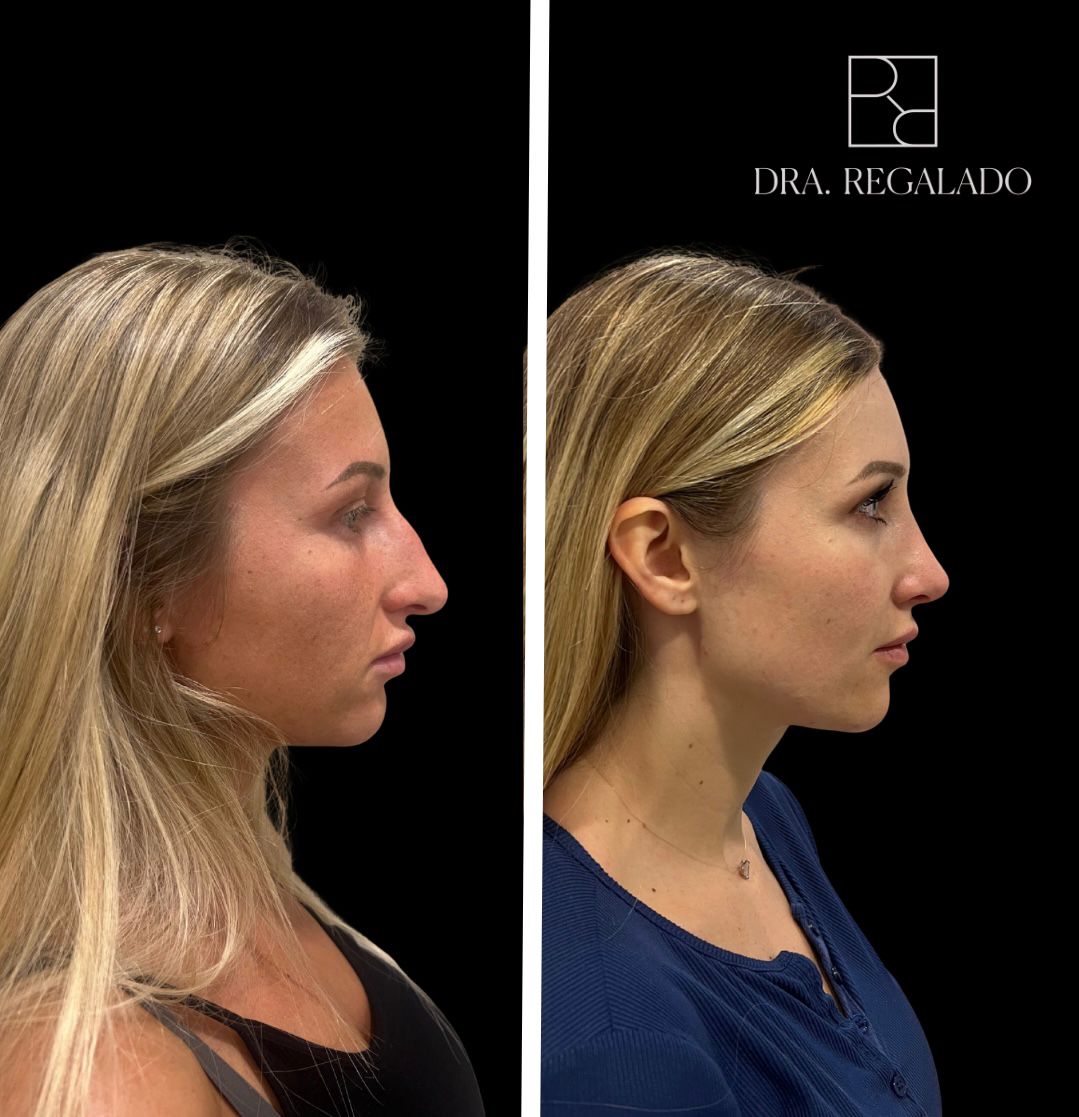 Rinoplastia ultrasónica
